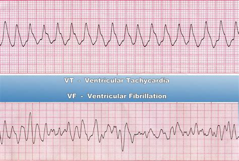 Ventricular Tachycardia - illness.com