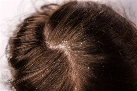 What Are the Causes of Dandruff and How to Rid