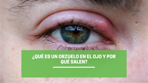 ¿Qué es un orzuelo en el ojo y por qué salen? | clinicaortuno.es