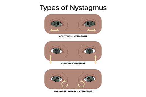 Nystagmus Dancing Eyes Types Symptoms Causes Treatmen - vrogue.co