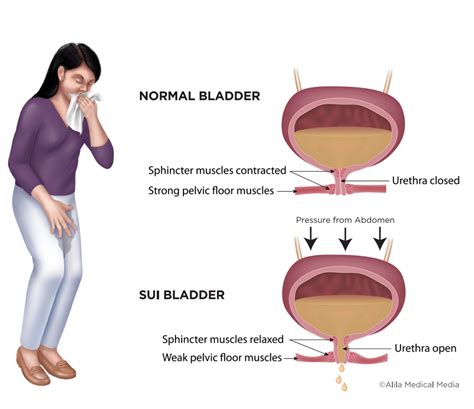 Stress Urinary Incontinence - Brazosport Women's Health