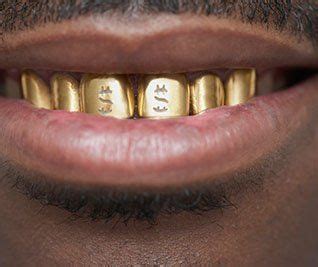 What to Know About Getting Gold Teeth