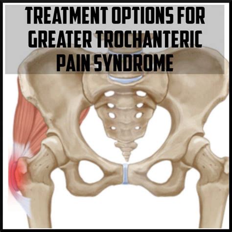 Treatment Options for Greater Trochanteric Pain Syndrome - Sports ...