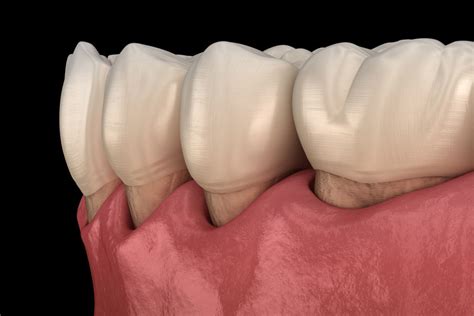 Advanced Gum Recession Treatment | PerioWest