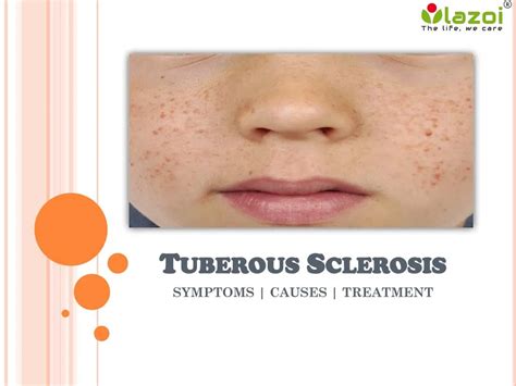 PPT - Tuberous Sclerosis : Causes, Symptoms, Diagnosis, Prevention and ...