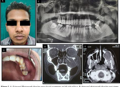 Figure 1 from Maxillary sinus mucocele in a 20-year-old male: a case report of a rare occurrence ...