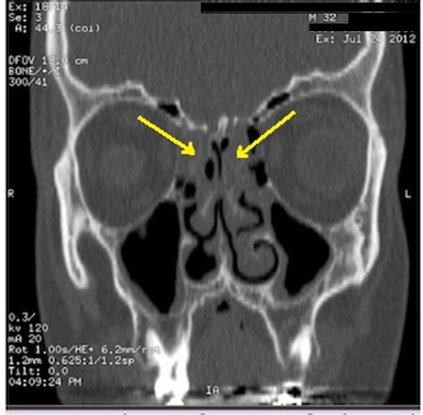 Nasal Polyp Ct Scan