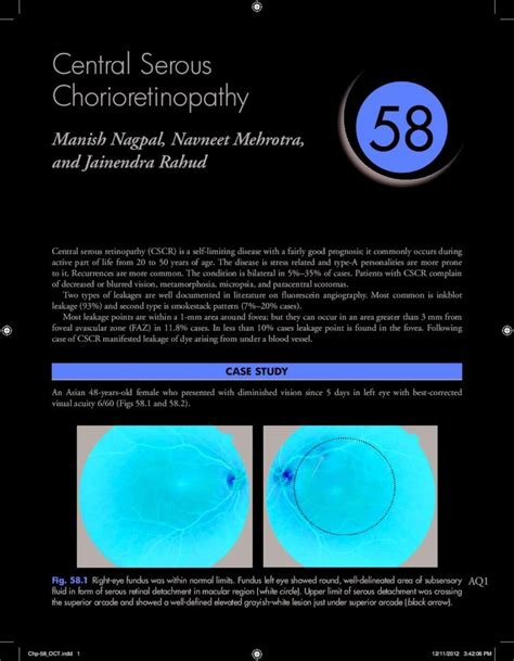 (PDF) Central Serous Chorioretinopathy 58€¦ · Central serous retinopathy (CSCR) is a self ...