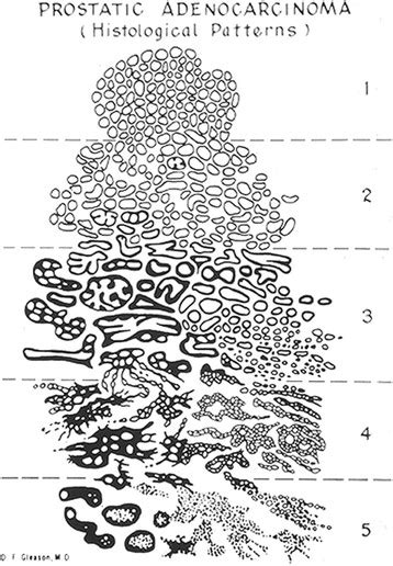 The original Gleason Grading system diagram | Download Scientific Diagram