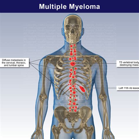 Multiple Myeloma - TrialExhibits Inc.