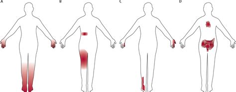 Diabetic neuropathy: clinical manifestations and current treatments ...