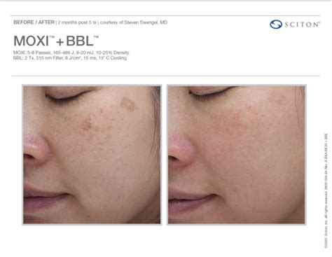 Moxi Laser in Charleston, SC – Gentle Skin Revitalization