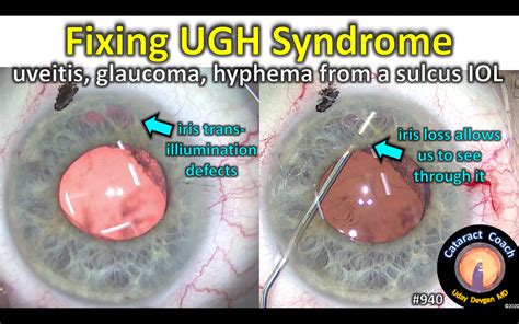 Fixing IOL-induced UGH Syndrome – Cataract Coach™