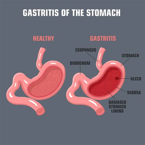 Gastritis - Drug Genius