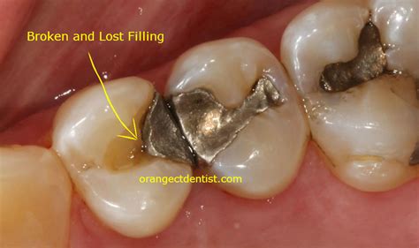 Lost or Broken Filling | Calcaterra Dentistry | Orange, Woodbridge CT