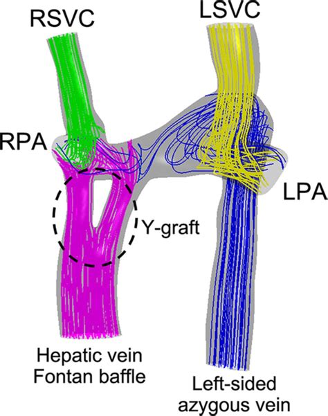 Role of imaging in the evaluation of single ventricle with the Fontan palliation | Heart