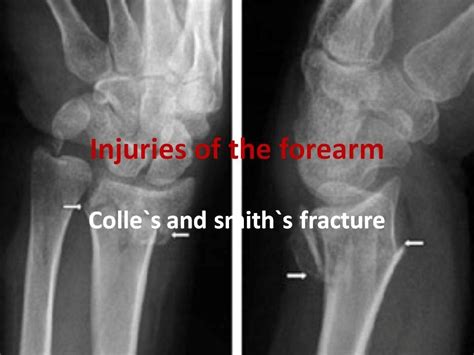 Colle`s and Smith`s fracture - YouTube