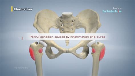 Hip Bursitis Video | Hip Orthopaedics Videos | Your Practice Online ...