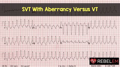 SVT With Aberrancy Versus VT - REBEL EM - Emergency Medicine Blog