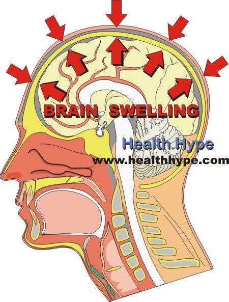 Sleepiness: Sleepiness Or Fatigue Causes Which Of The Following