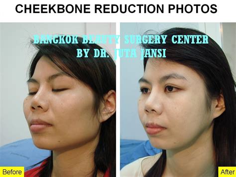 Bangkok Thailand Feminine Surgery