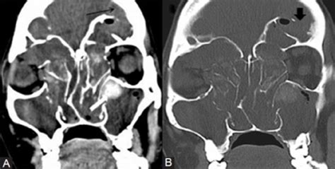 Coronal CT soft tissue (A) and bone window (B) reveal f | Open-i