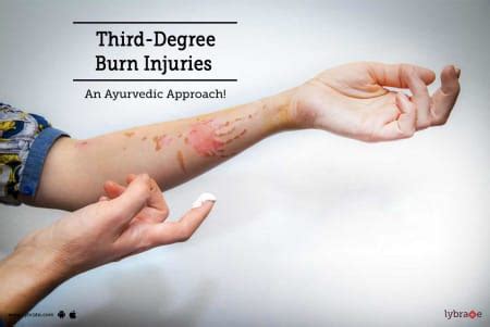 How To Cure Third Degree Burns - Partskill30
