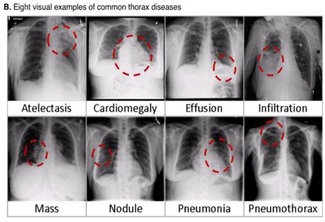 Chest X Ray Pneumonia Vs Lung Cancer