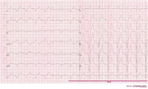 Accelerated idioventricular rhythm electrocardiogram - wikidoc