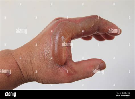 Second degree burn hi-res stock photography and images - Alamy