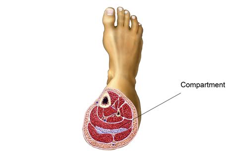 Compartment syndrome - NHS.UK