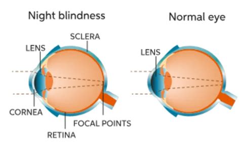 Night Blindness (Nyctalopia): What It Is, Causes & Treatment