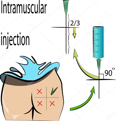 Intramuscular Injection Diagram