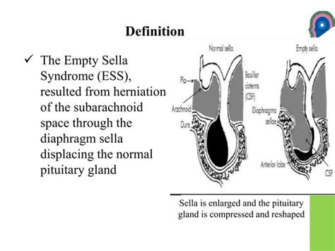 Empty sella syndrome