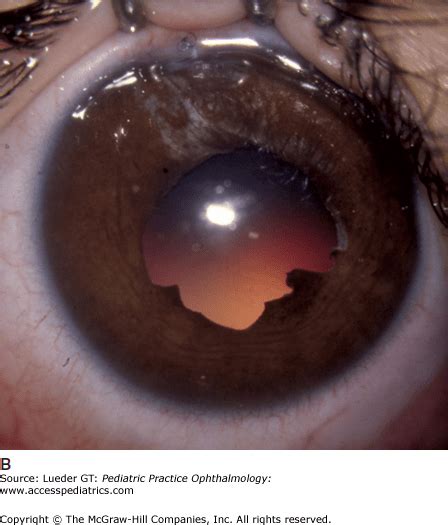 Disorders of the Iris and Pupil | Ento Key