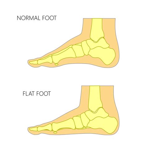 Flat Foot (Pes Planus)