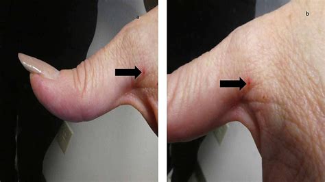 Cureus | Classic and Non-classic (Surrepticius) Scabies: Diagnostic and Treatment Considerations