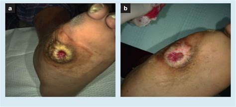 The influence of adequate debridement and placental-derived allografts on diabetic foot ulcers ...