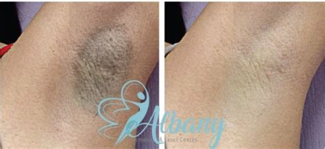 Underarm Whitening Edmonton : Results, Cost and Safety - Ulthera Edmonton