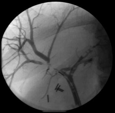 Bile Duct Strictures: Background, Pathophysiology, Etiology