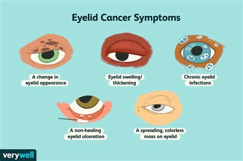 Eyelid Cancer: Overview and More
