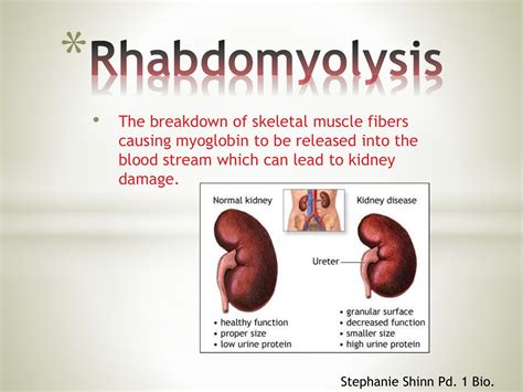 Rhabdomyolysis