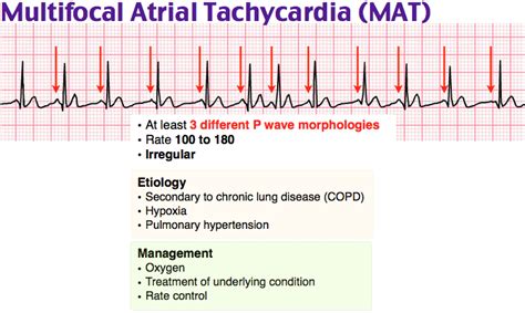 Multifocal Atrial Tachycardia Strip