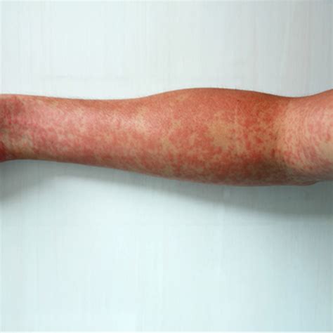 What is Vasculitis? Symptoms and Treatment in Australia.