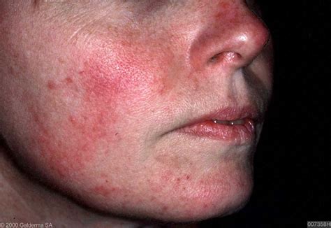 Acne rosacea Home Remedy and other natural treatments