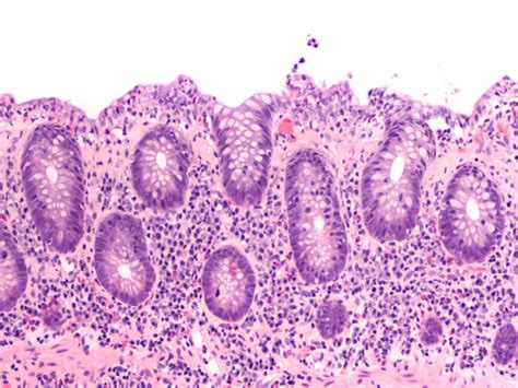 Microscopic Colitis Symptoms, Causes & Treatment