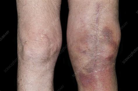 Infected total knee replacement - Stock Image - C014/7969 - Science Photo Library