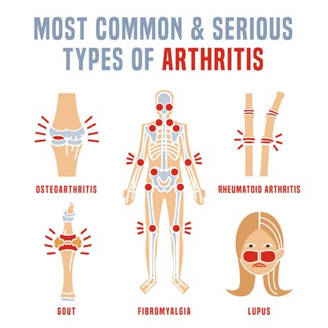 Steps to Reduce Your Risk Of Developing Some Types Of Arthritis