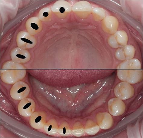 Size and location of access cavities in maxillary and mandibular teeth... | Download Scientific ...