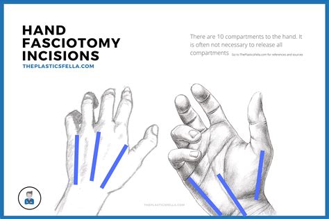 Hand Compartment Syndrome